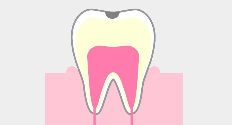 虫歯C1